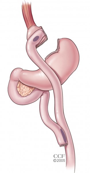 020_Roux-en-Y-gastric-bypass